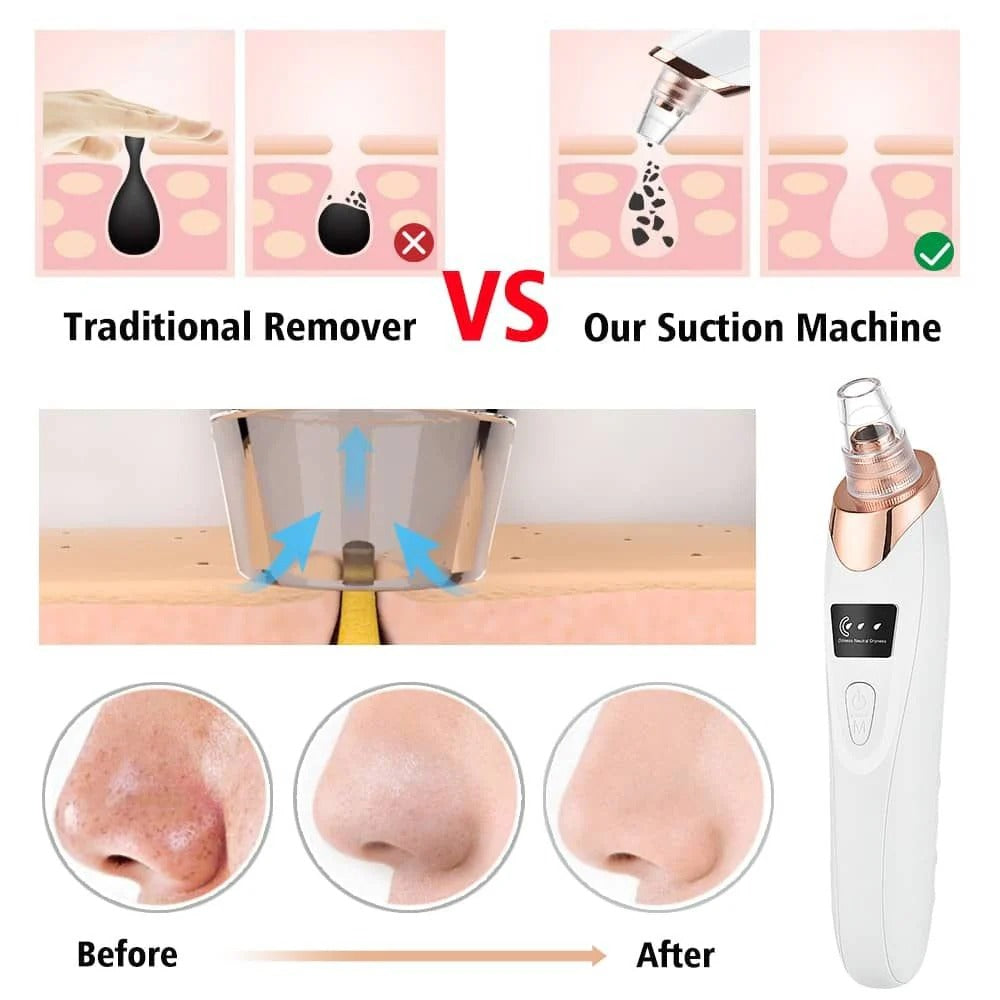 Electric Blackhead Remover | 5-Head Pore Cleaner Vacuum | Acne & Facial Pore Suction Device
